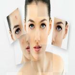 Get Rid of Acne  (Guide)