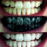 ”Teeth whitening (Guide)