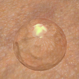Pimples & Zits