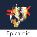 Atrial Fibrillation