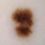 ”Skin Cancer Flashcard "game"