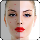 Acne Free : Pimple Remover APK