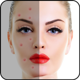 Acne Free : Pimple Remover