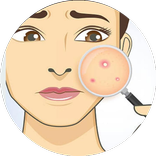 Acne Rescuers
